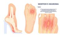 Comprendre le syndrome de  Morton : Causes et symptômes